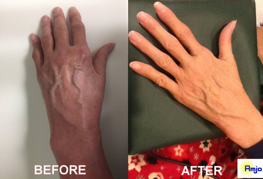 CRPS Hand Before and After Curatron PEMF